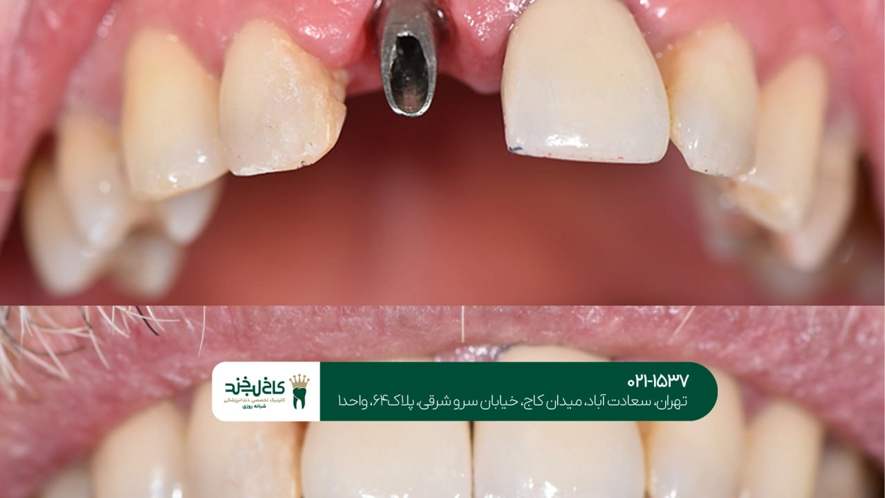درمان ایمپلنت بدون درد درمان ایمپلنت بدون درد
