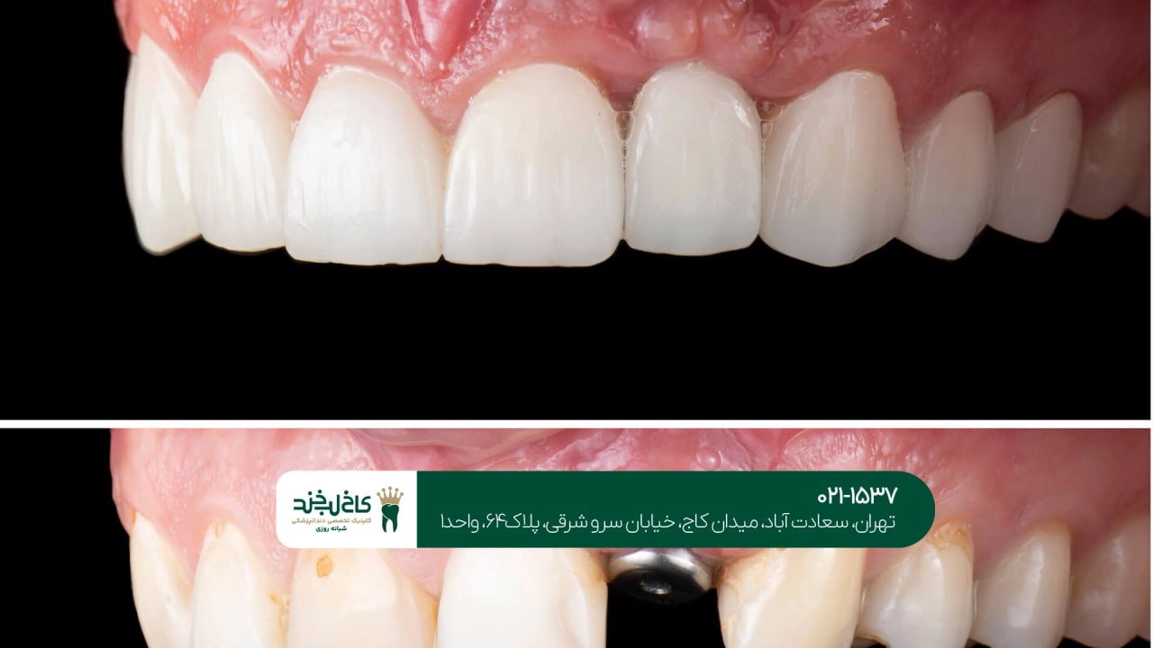 درمان ایمپلنت بدون درد درمان ایمپلنت بدون درد