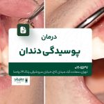 درمان پوسیدگی دندان