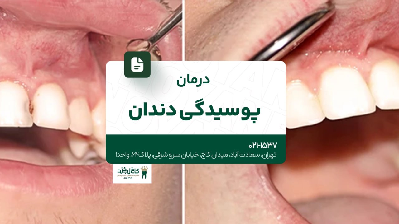درمان پوسیدگی دندان درمان پوسیدگی دندان