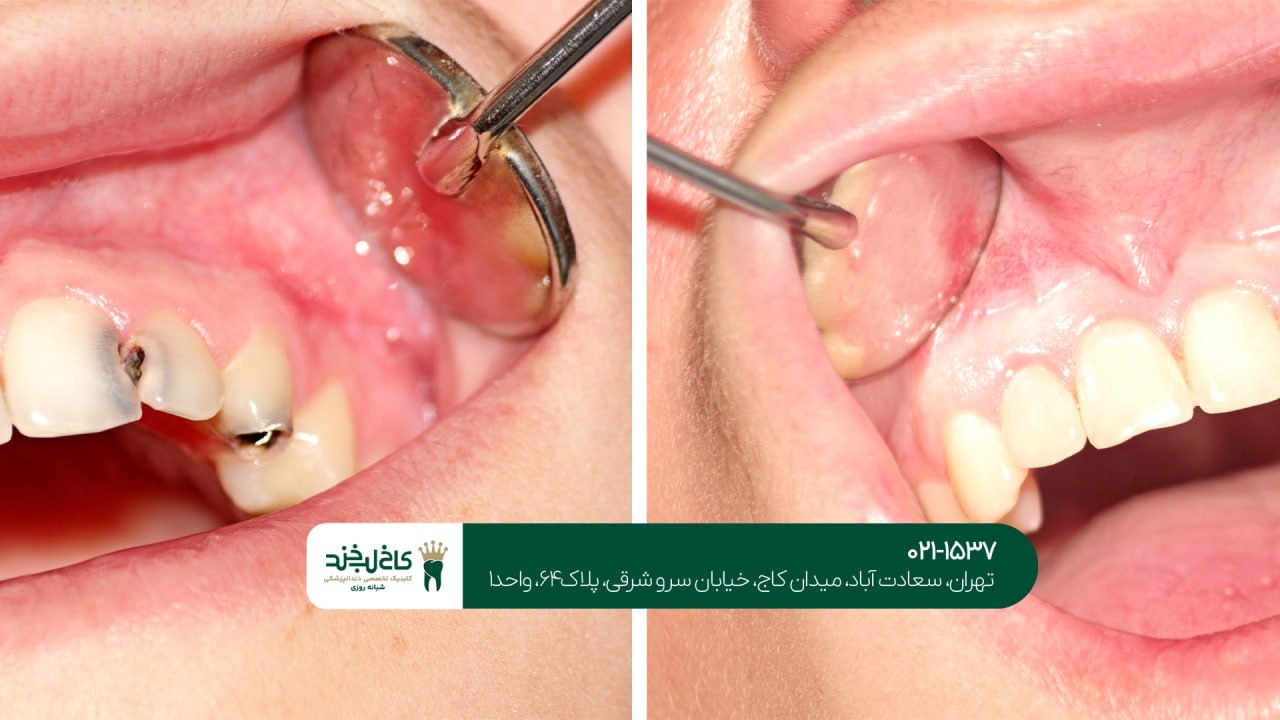 درمان پوسیدگی دندان درمان پوسیدگی دندان