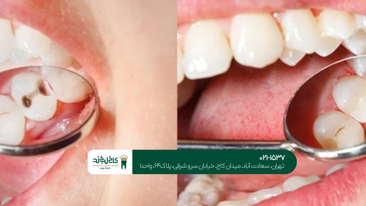 درمان پوسیدگی دندان درمان پوسیدگی دندان