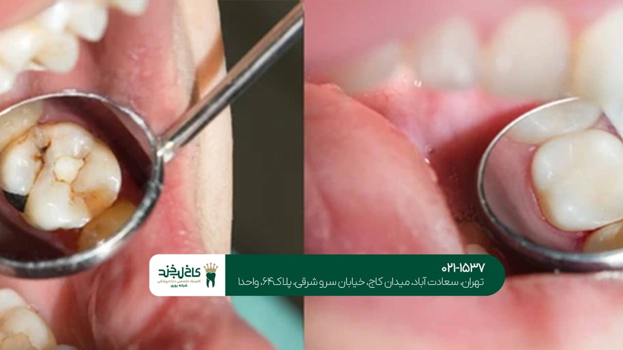 درمان پوسیدگی دندان درمان پوسیدگی دندان