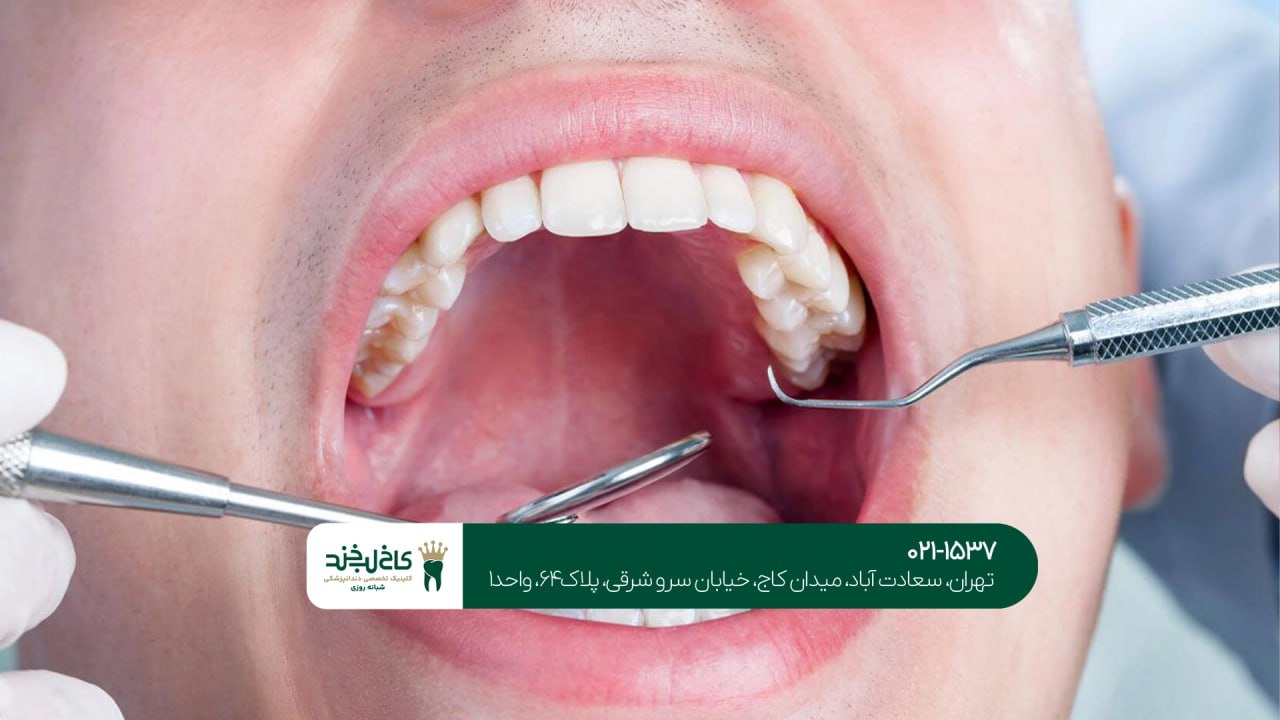 پر کردن دندان پر کردن دندان