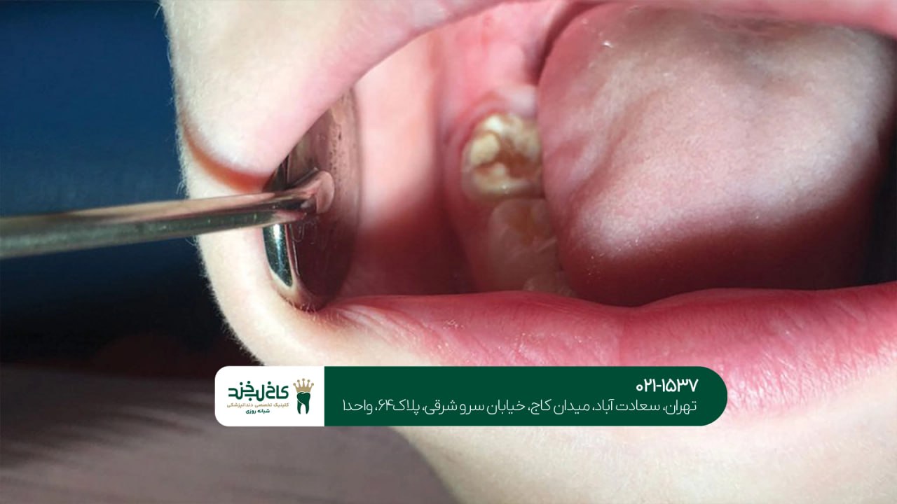 پر کردن دندان پر کردن دندان