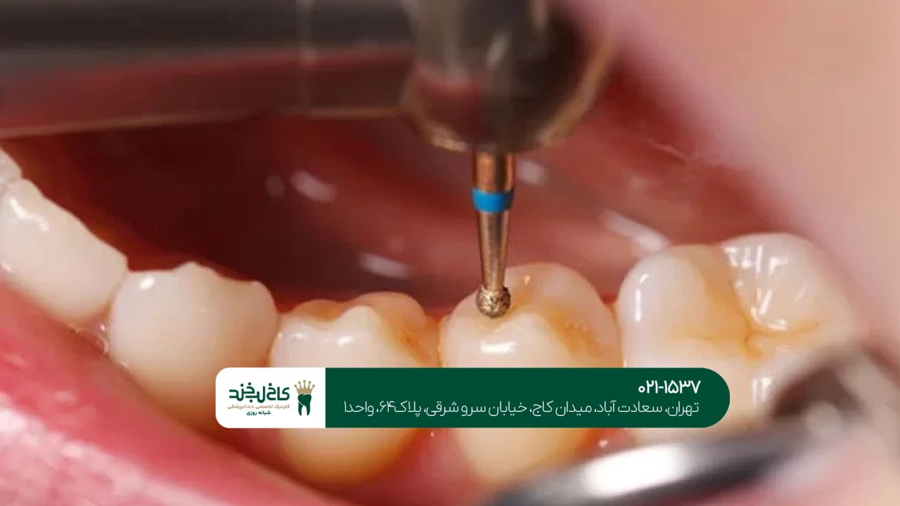 پر کردن دندان پر کردن دندان