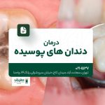 درمان دندان های پوسیده