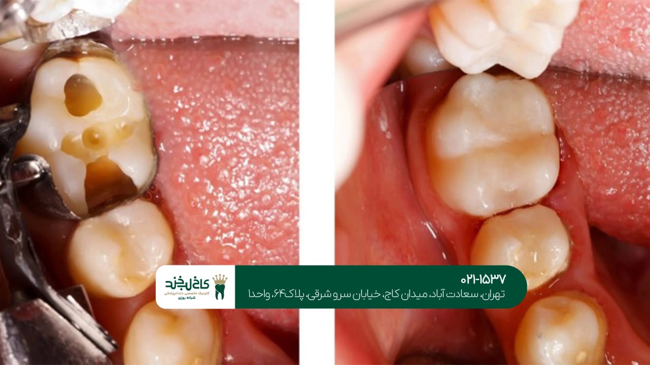 درمان دندان های پوسیده درمان دندان های پوسیده
