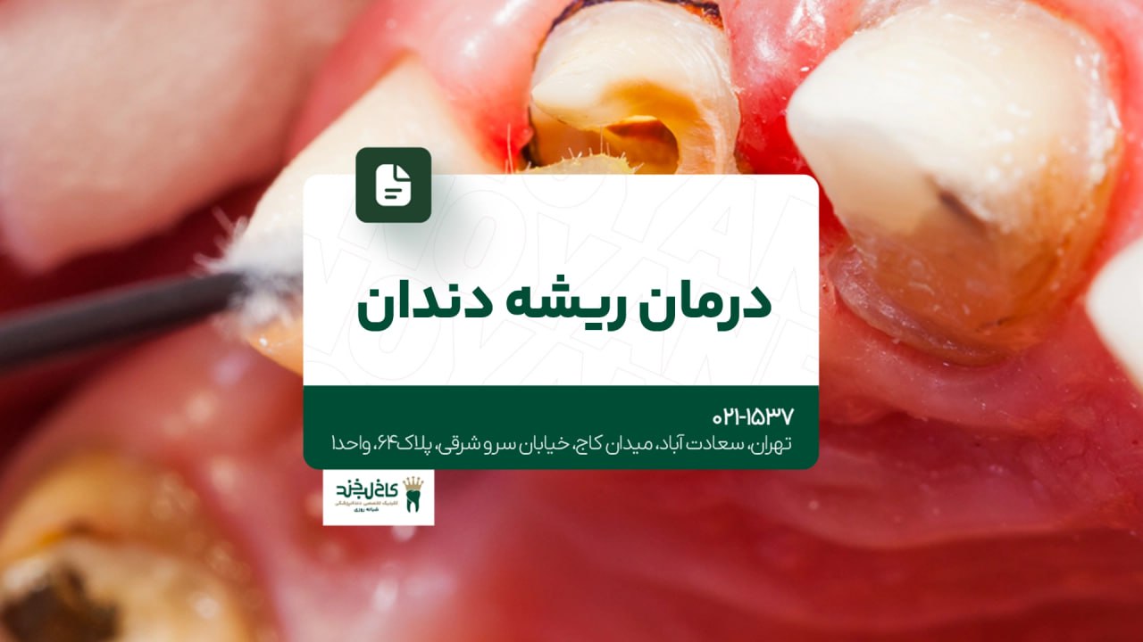 درمان ریشه دندان