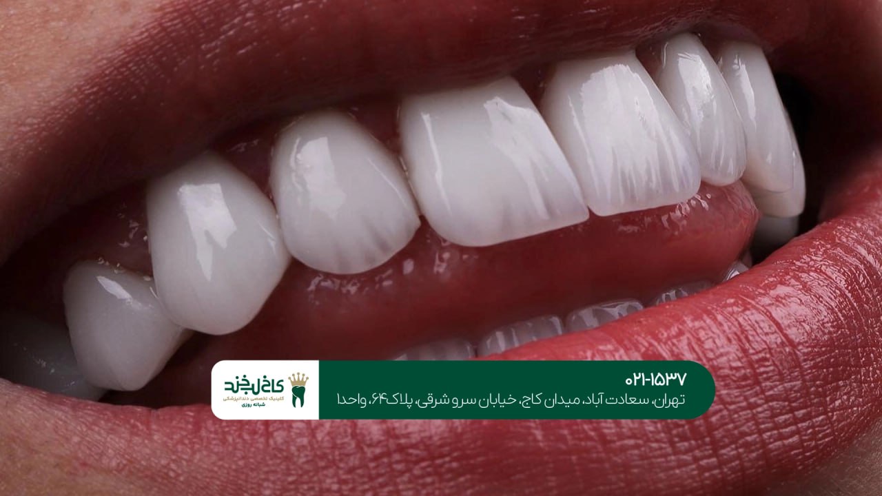 لمینت دندان طبیعی در تهران