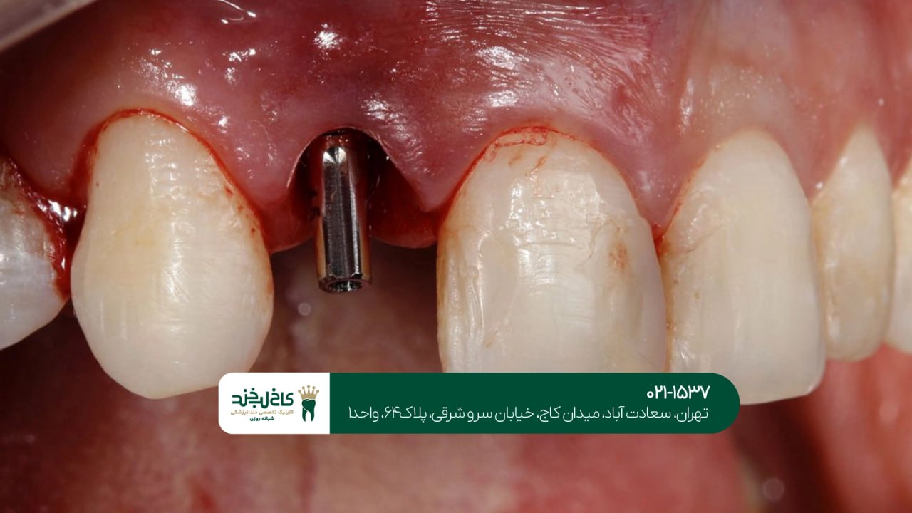 مرکز ایمپلنت سعادت آباد