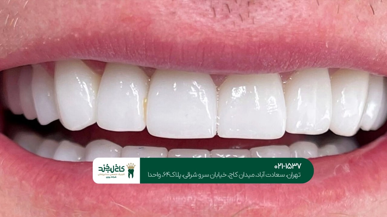 کامپوزیت دندان سعادت آباد