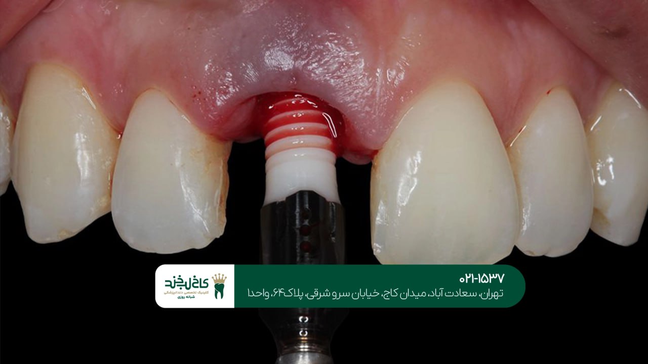 اصلاح طرح لبخند با ایمپلنت