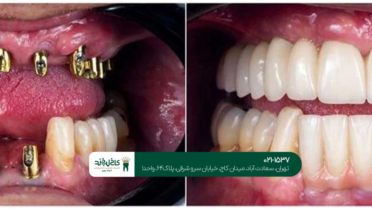 ایمپلنت همراه کامپوزیت