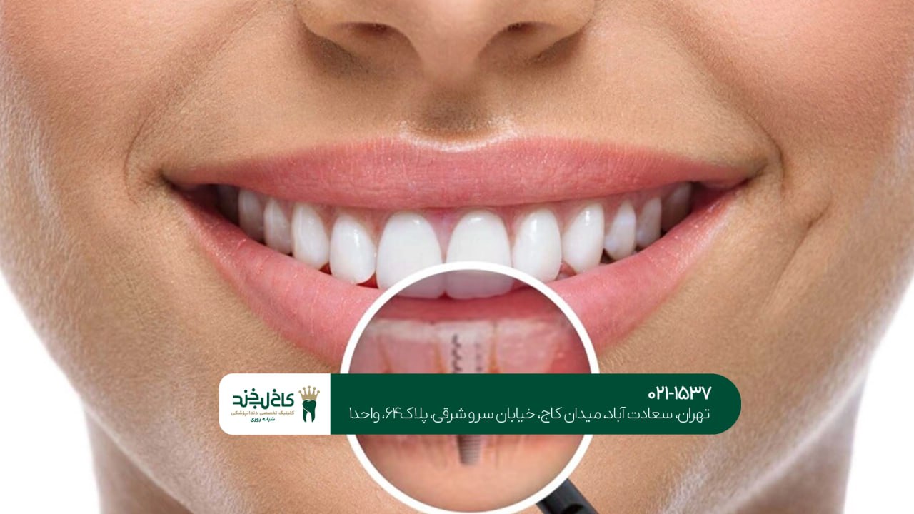 ایمپلنت برای زیبایی