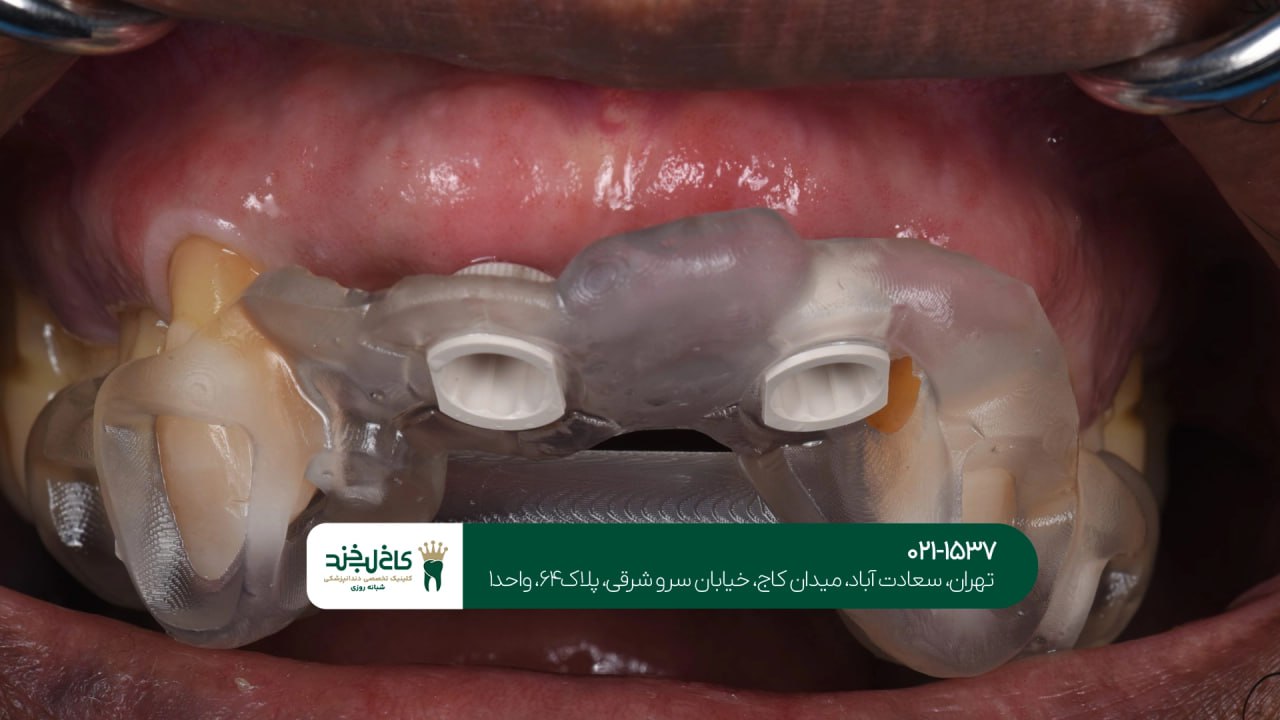 ایمپلنت دیجیتال پیشرفتهایمپلنت دیجیتال پیشرفته