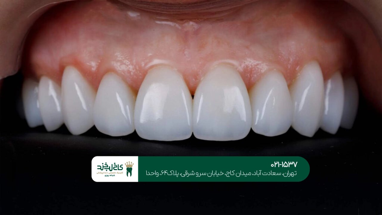 بهترین طراحی لبخند در تهران