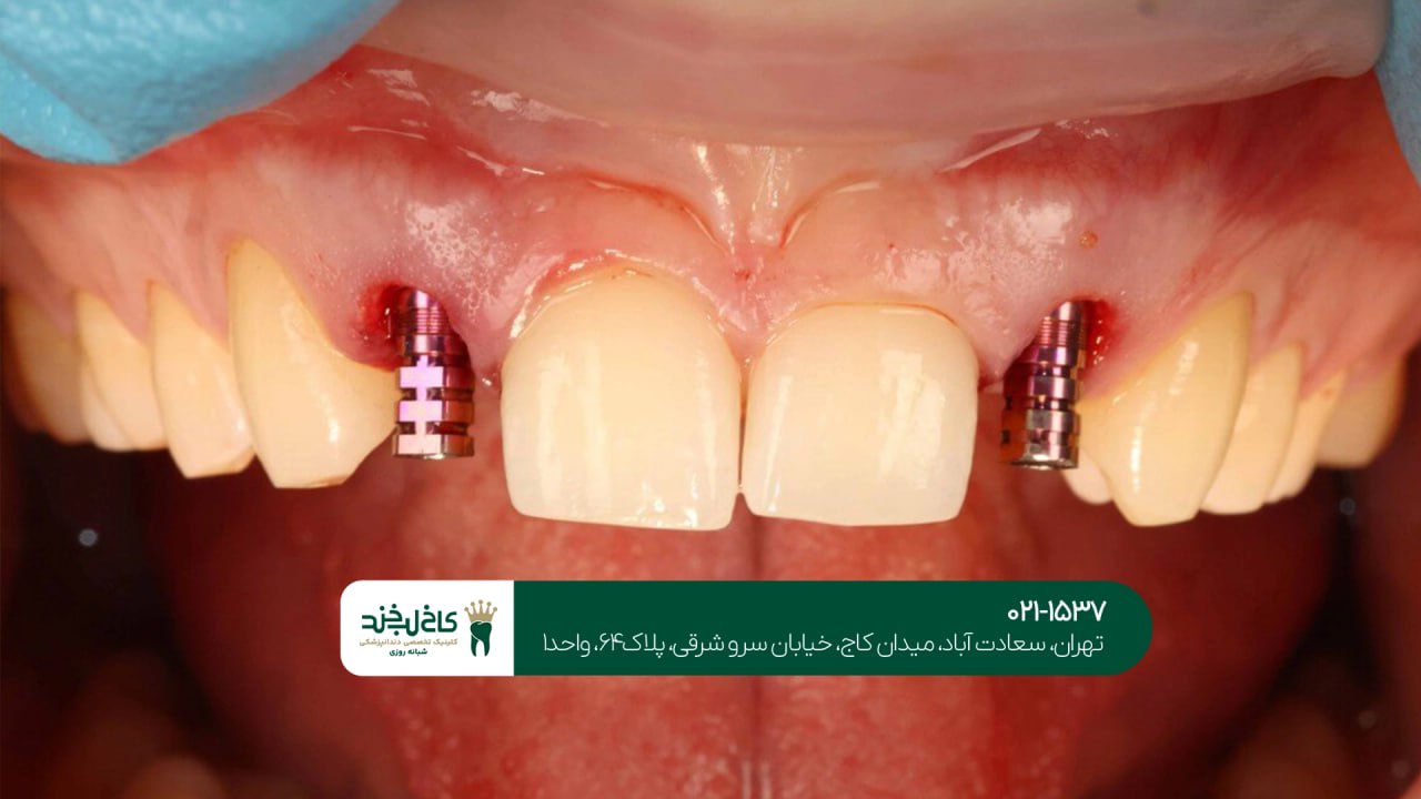 جراحی دیجیتال ایمپلنت