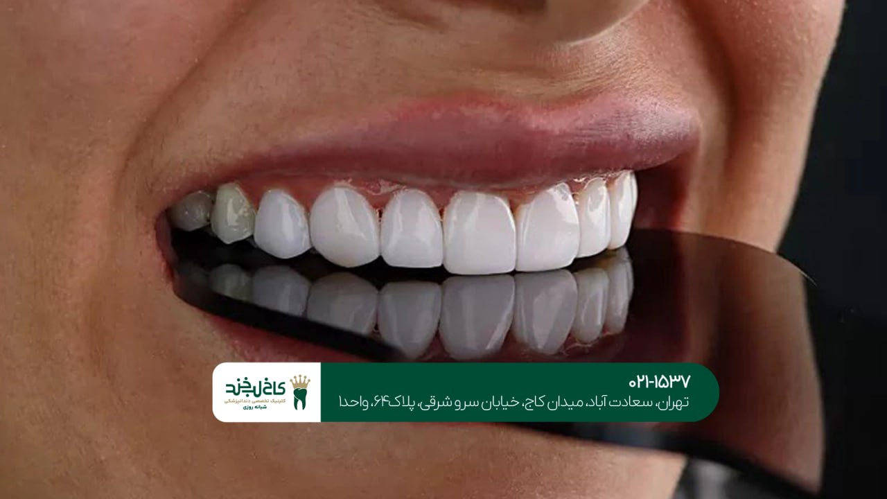 کلینیک لمینت حرفهای تهران