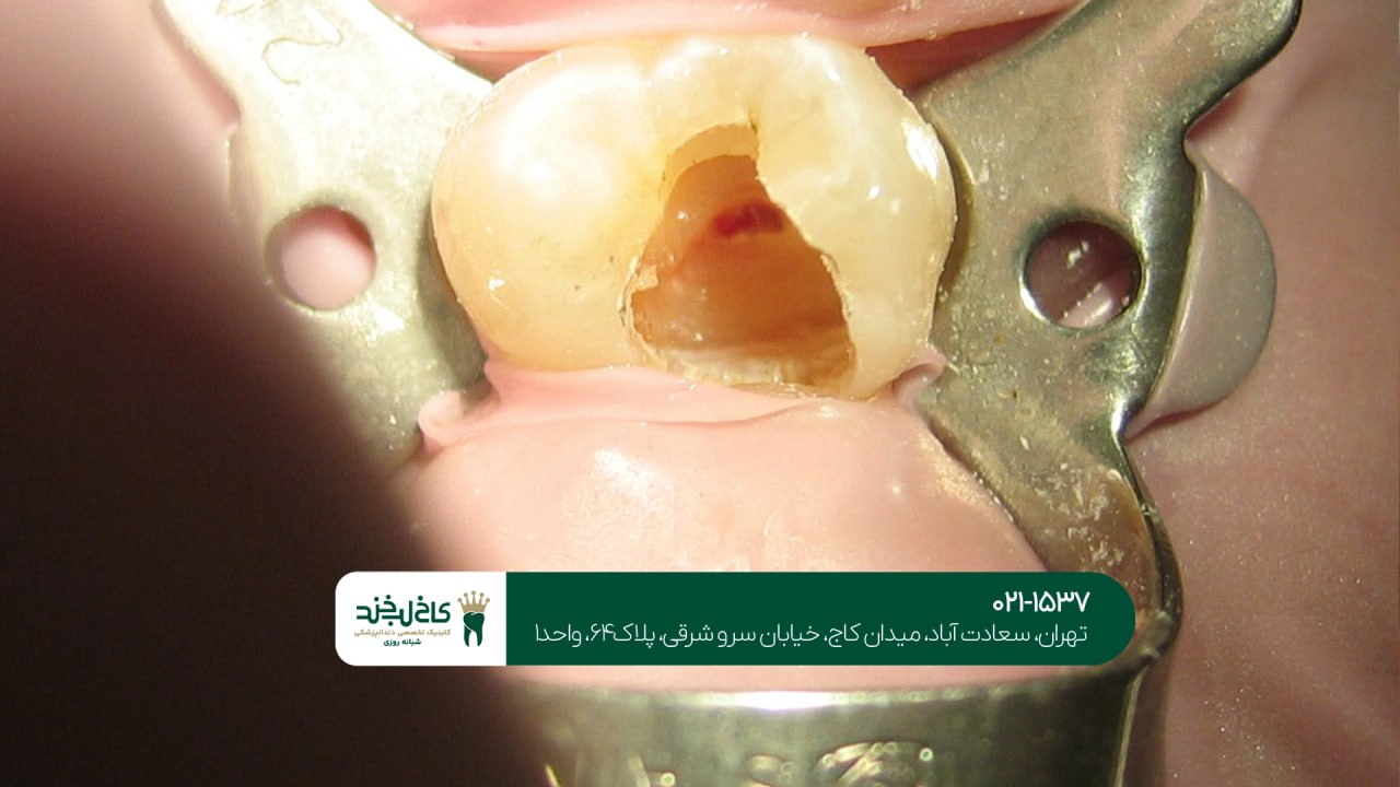 ترمیم ریشه دندان به صورت تخصصی