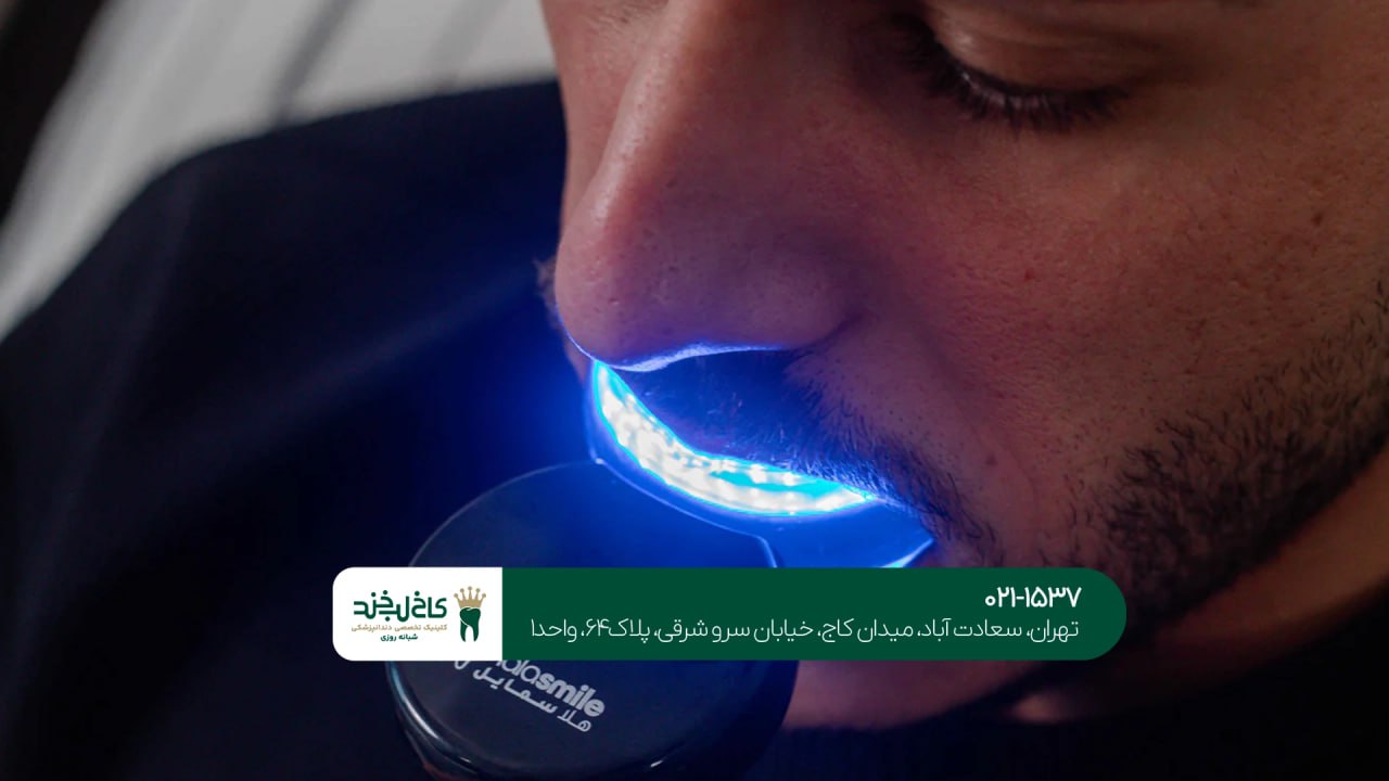 سفید کردن دندان حرفهای