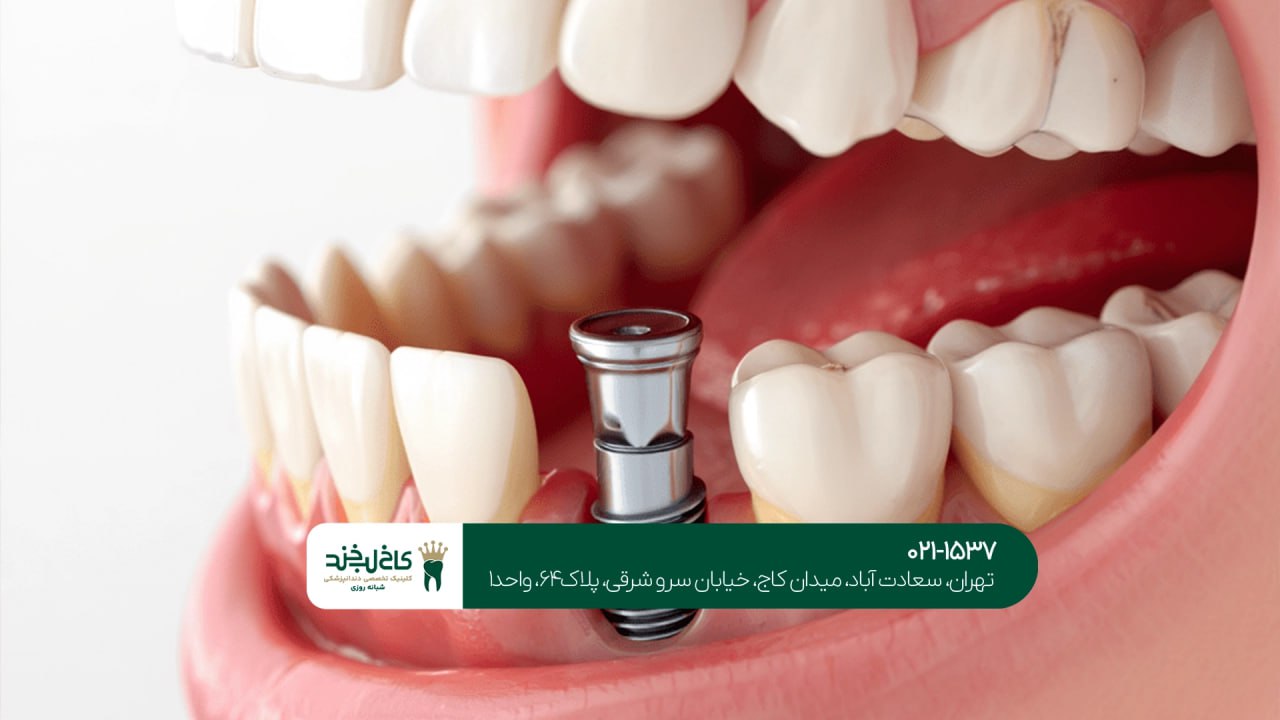 دندانپزشکی ایمپلنت در تهران