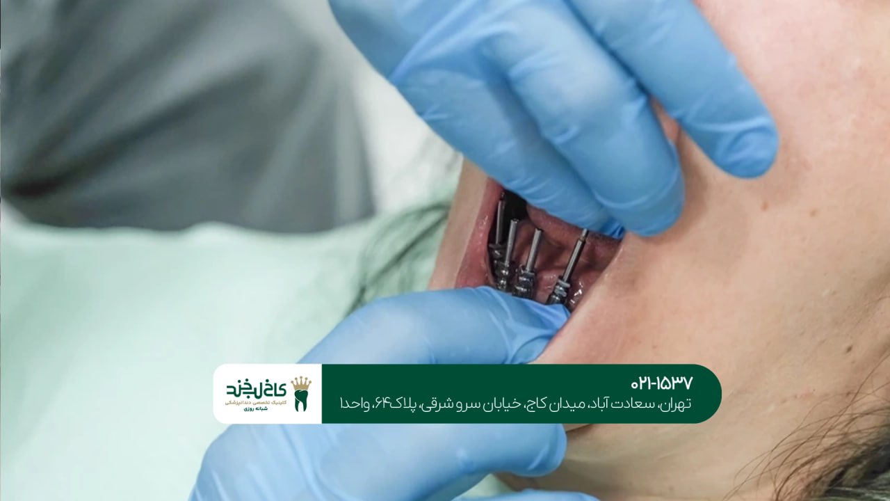 ایمپلنت دیجیتال بدون جراحی