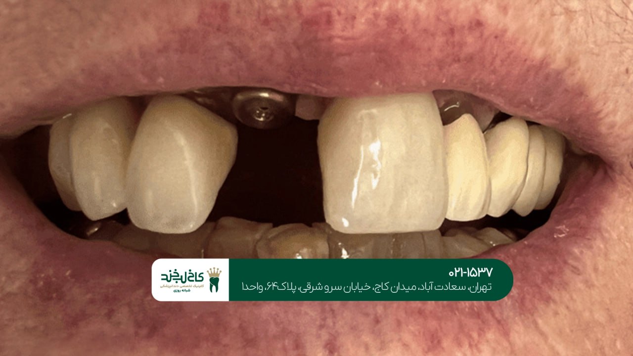 ایمپلنت دندان با تکنولوژی روز