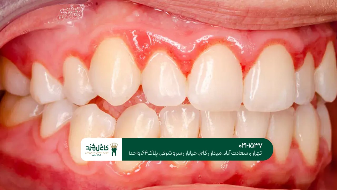 درمان دندانهای حساس