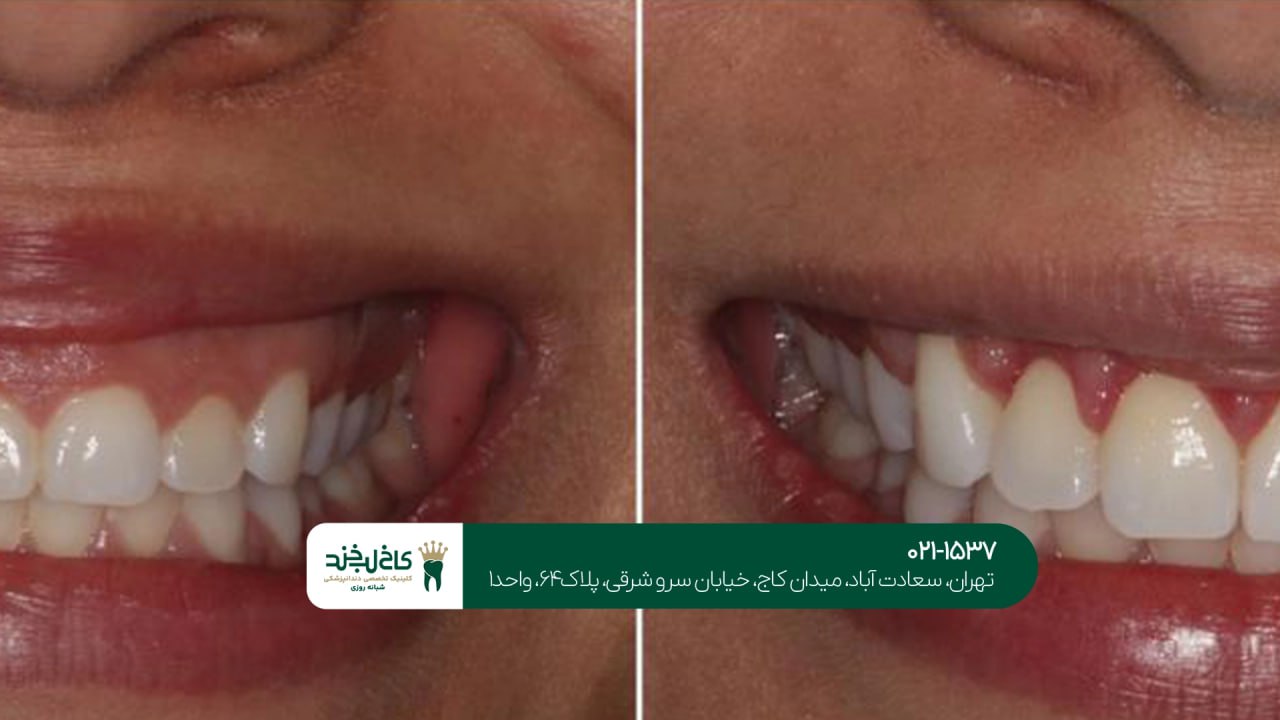 درمان لبخند لثهای