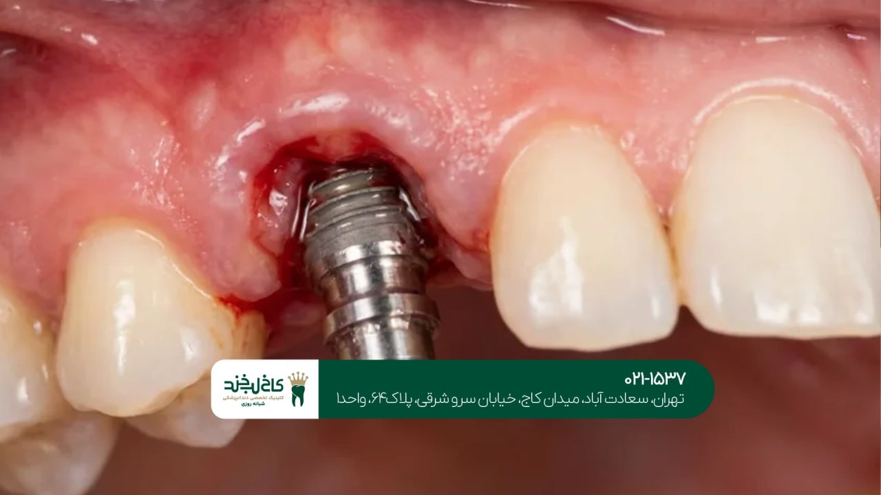 درمانهای تخصصی ایمپلنت
