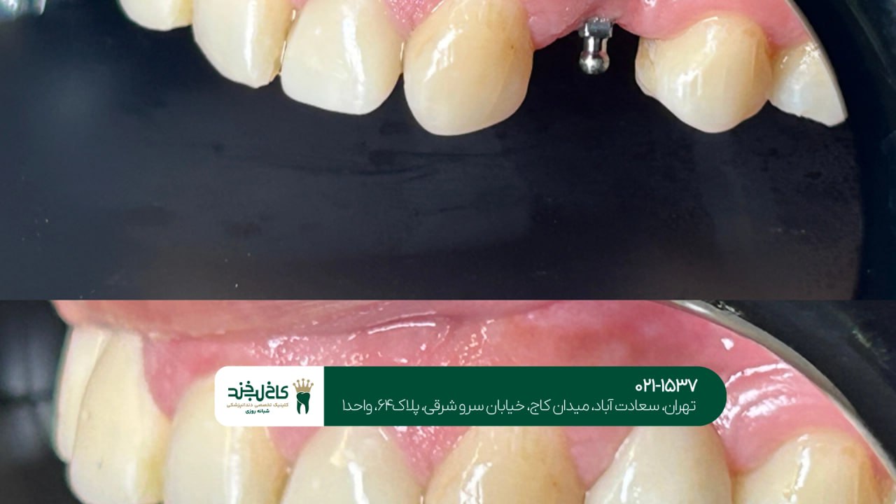 ایمپلنت دندان یک روزه