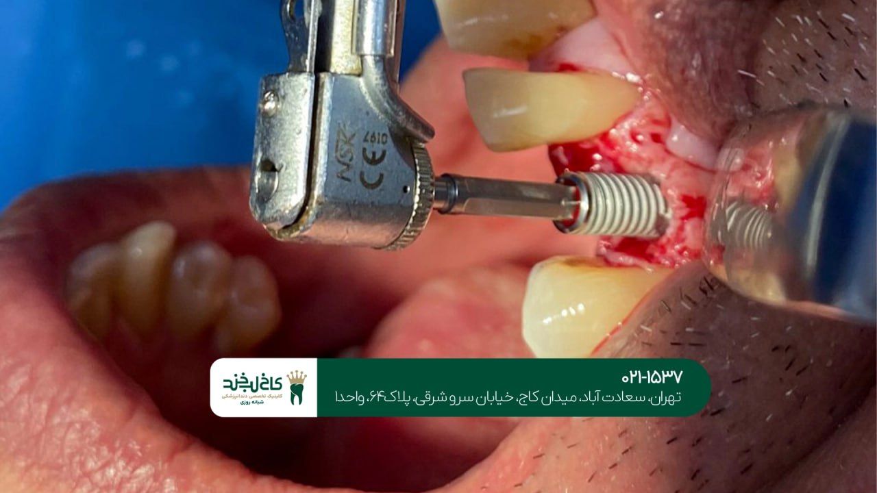 مشاوره ایمپلنت دندان