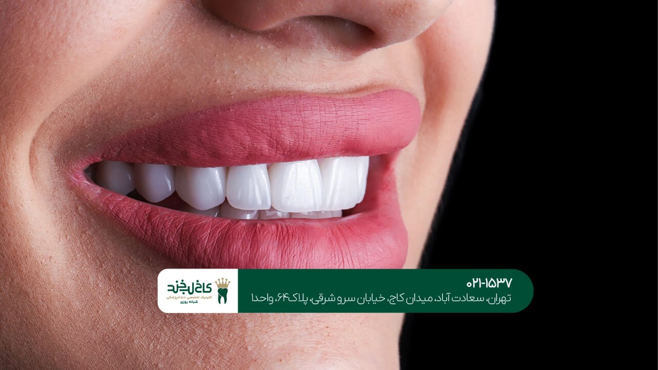 لمینت دندان طبیعی در تهران