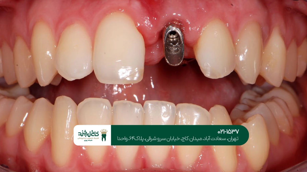 مرکز ایمپلنت سعادت آباد