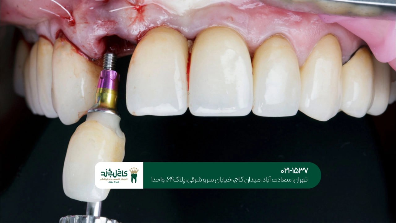 اصلاح طرح لبخند با ایمپلنت