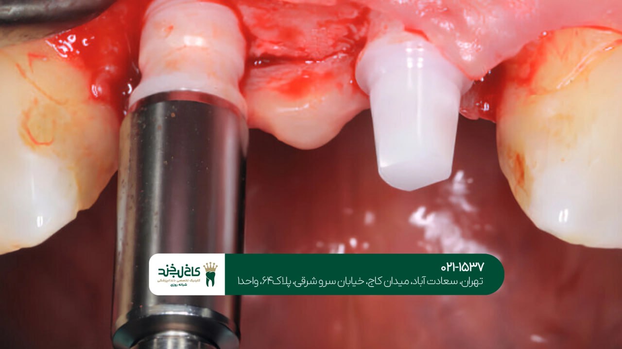 ایمپلنت همراه روکش زیرکونیا