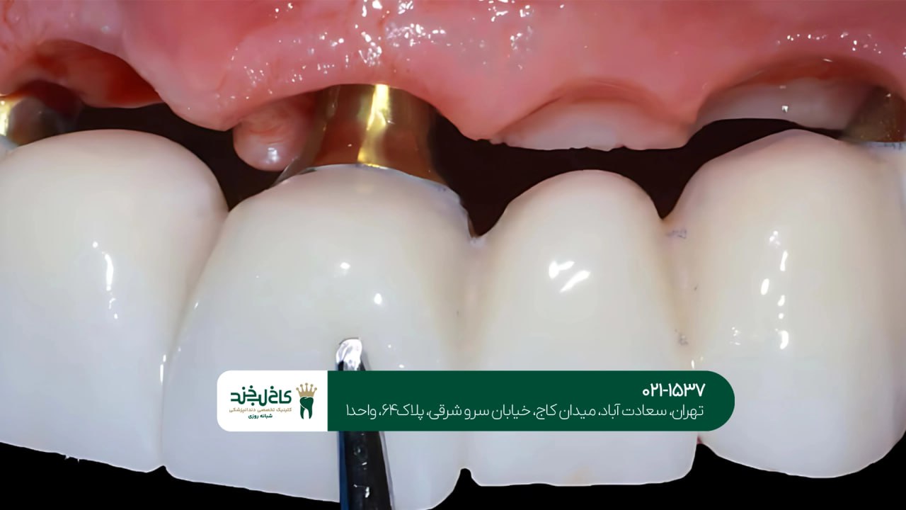 ایمپلنت همراه کامپوزیت