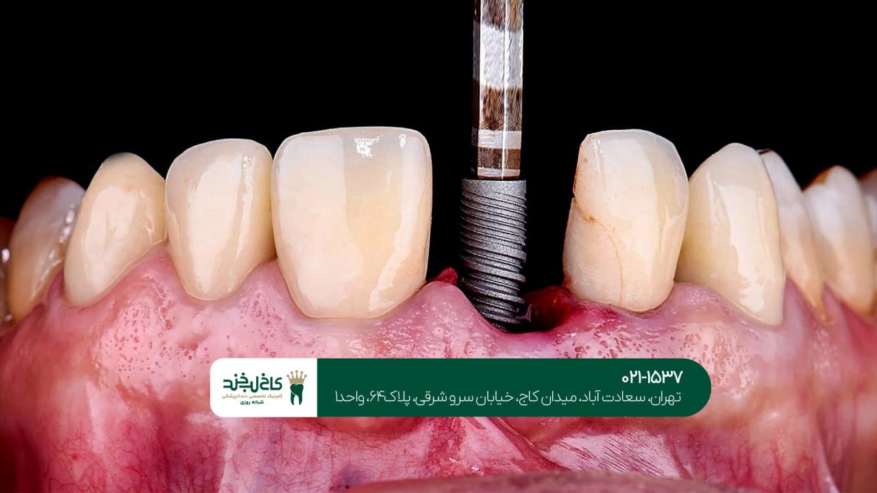 بهترین دندانپزشکی ایمپلنت تهران