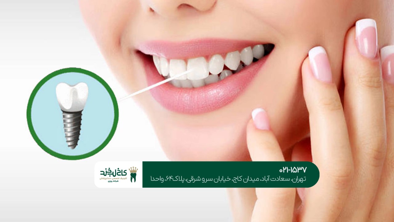 ایمپلنت برای زیبایی