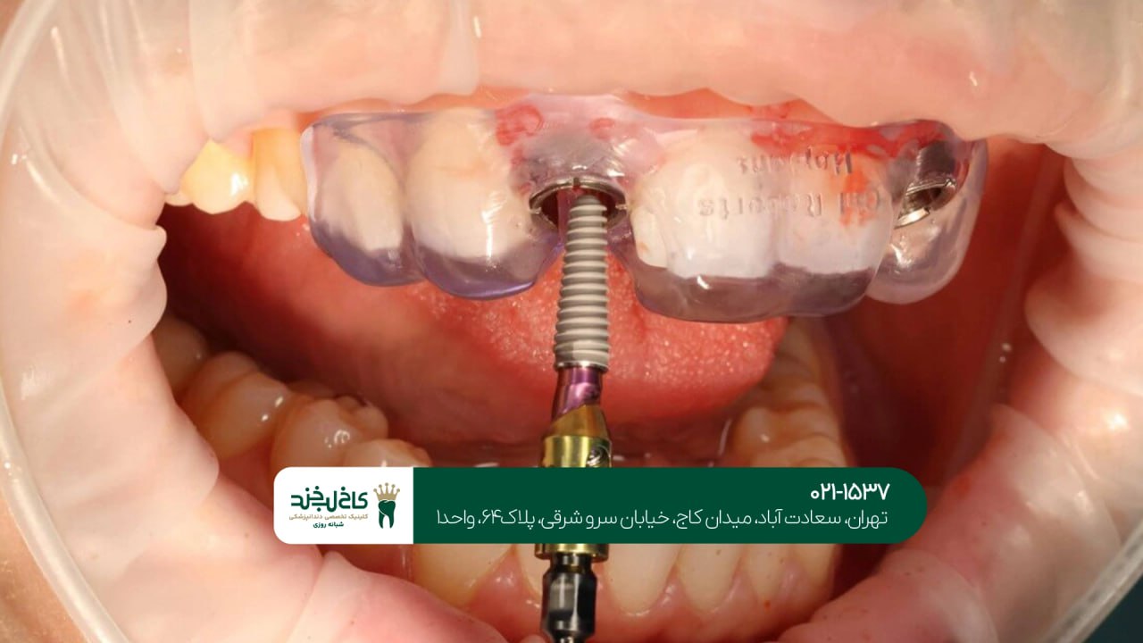 جراحی دیجیتال ایمپلنت