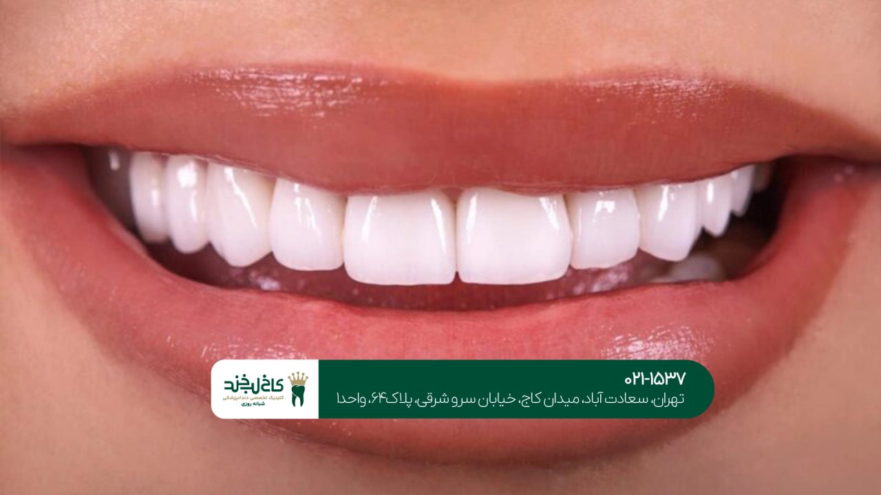 کلینیک لمینت حرفهای تهران