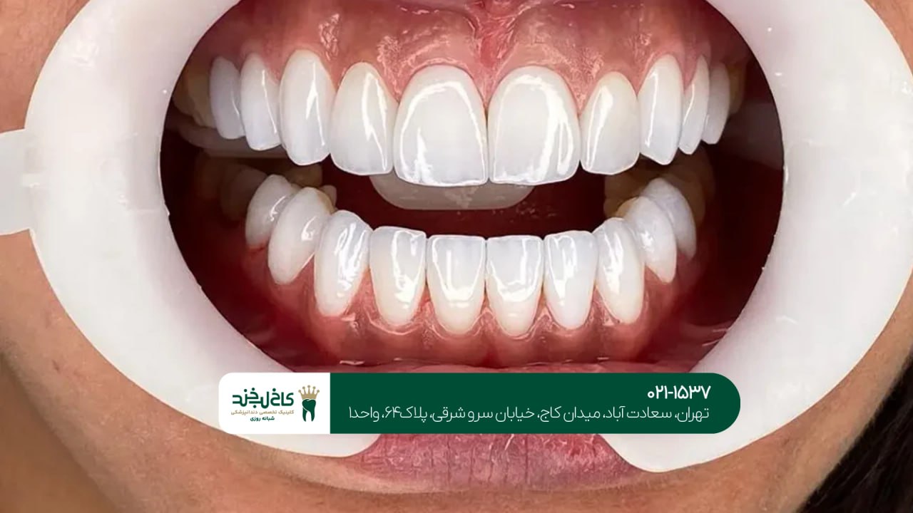 لمینت سرامیکی