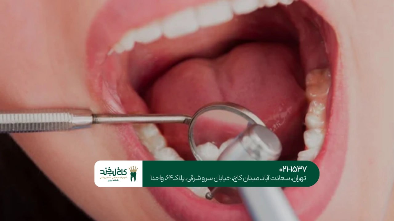 جرمگیری تخصصی دندان