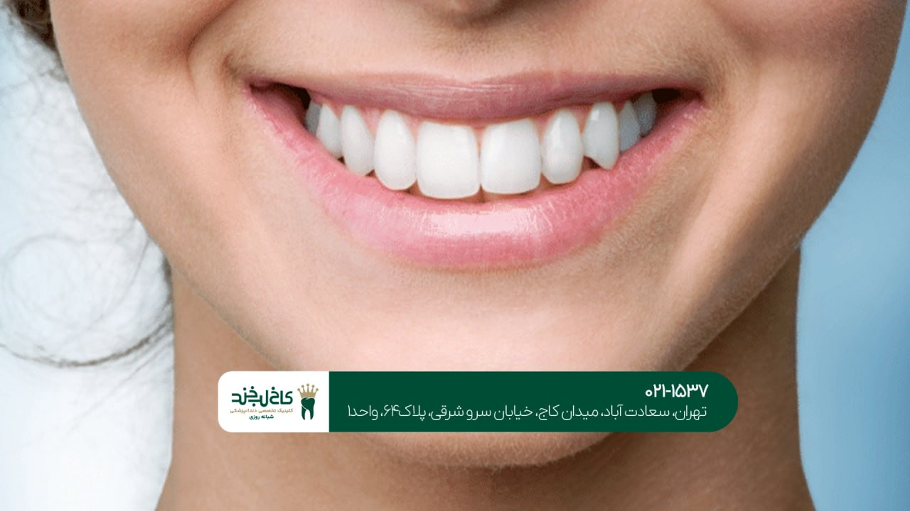 بهترین روش زیبایی دندان