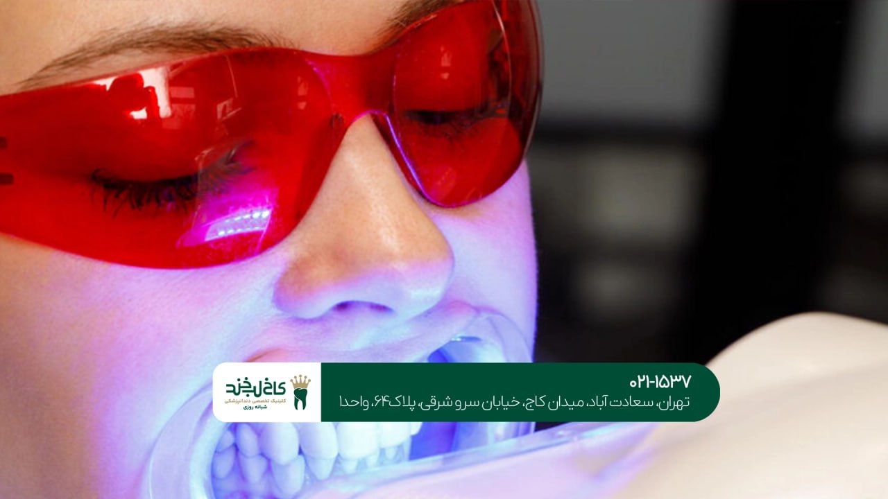 بلیچینگ در کلینیک دندانپزشکی