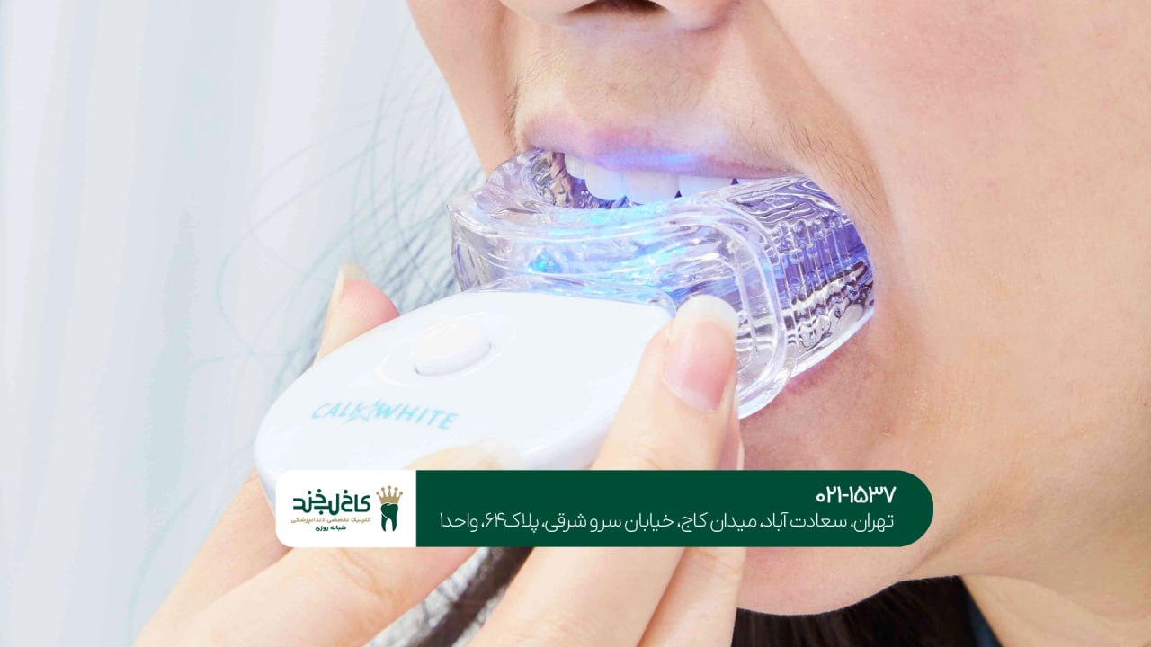 سفید کردن دندان حرفهای