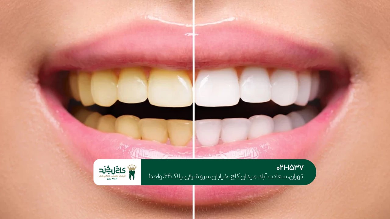 بهبود رنگ دندان