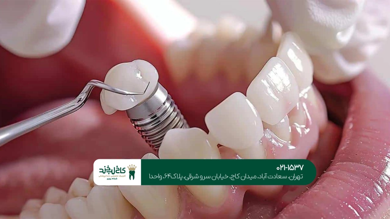 دندانپزشکی ایمپلنت در تهران