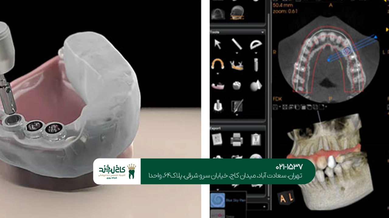 ایمپلنت دیجیتال بدون جراحی